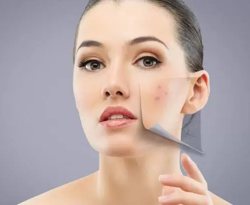 laser-acne-and-scar-treatment-in-kanpur