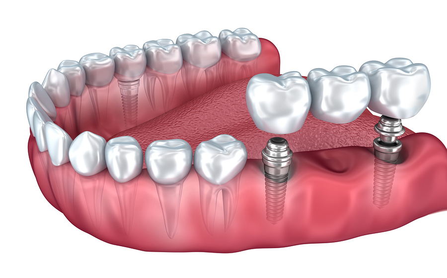 Multiple Tooth Implants in Kanpur