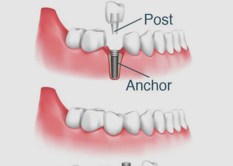 What are Dental implants