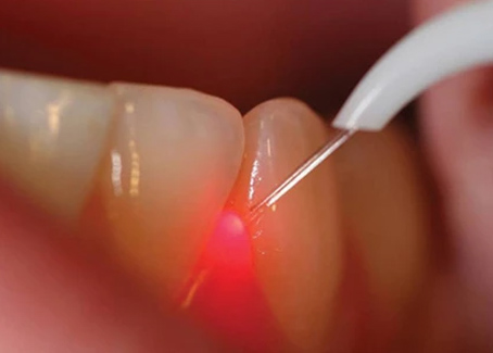 What is Laser Dentistry