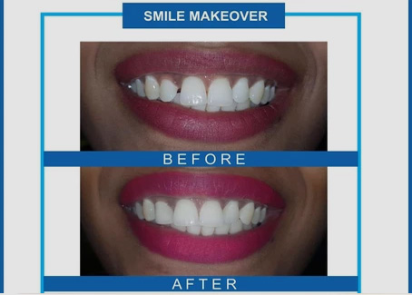 What is Smile Makeover